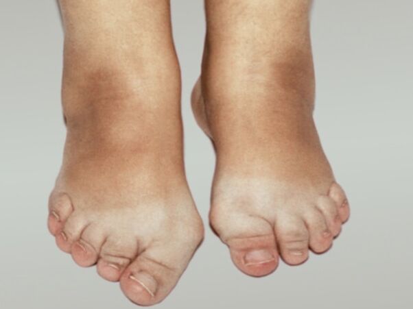 足部骨关节炎，脚趾严重变形