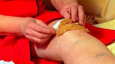 压缩膝关节关节