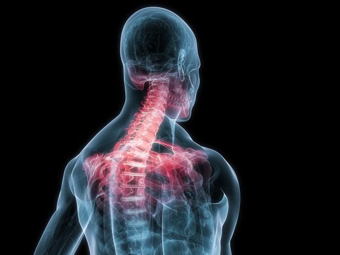 颈椎骨软骨病是椎间盘突出症的一种变体