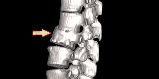 脊柱病理学作为背痛的原因