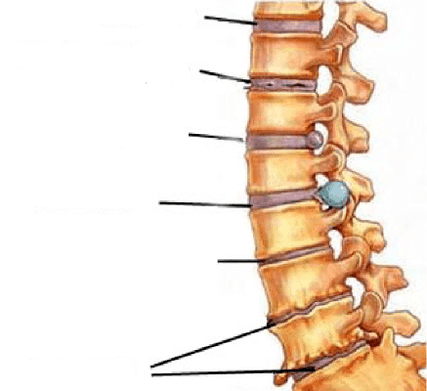 脊柱骨软骨病的发展阶段