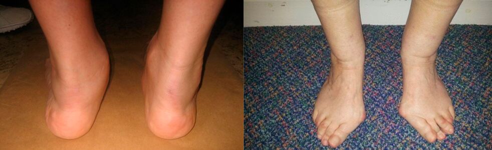 大脚趾关节和踝关节变形