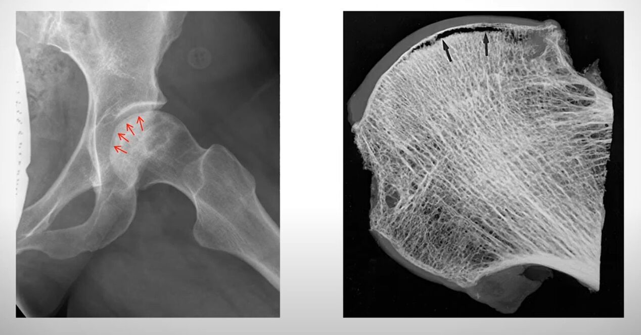 无菌性坏死影响股骨头的 X 光片
